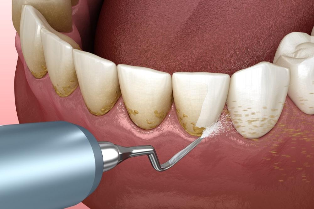 What is dental scaling and root planing? | Flushing, New York City