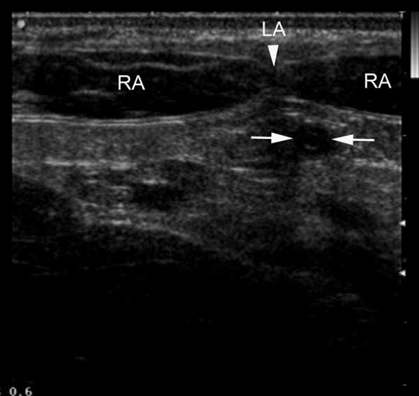 Normal umbilical vein located deep and adjacent to rectus abdominus muscle bellies near linea alba