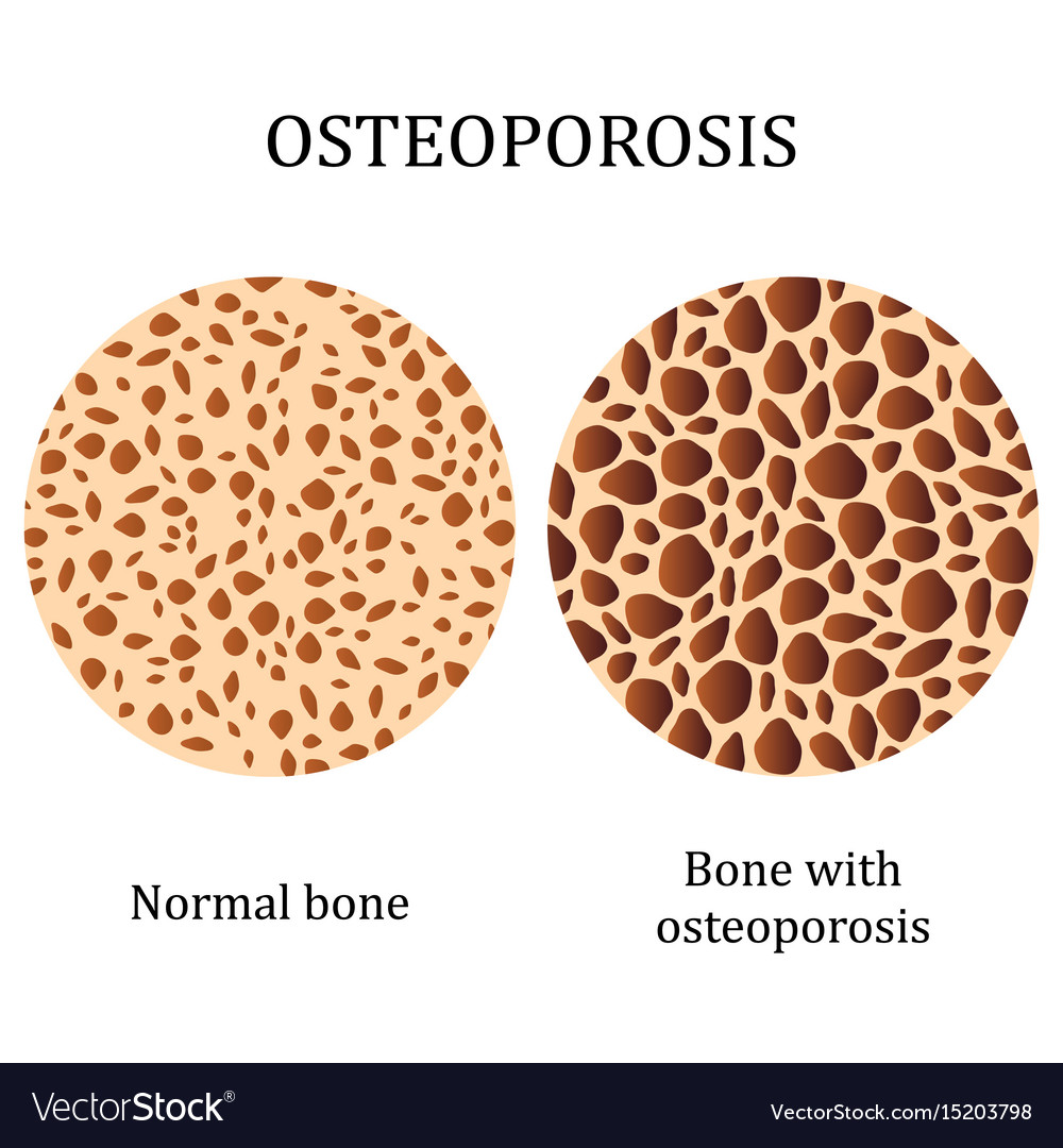 هشاشة العظام (osteoporosis) 
