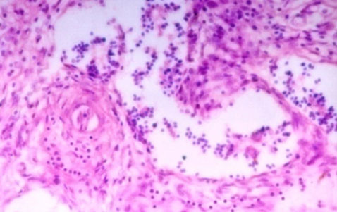 Microscopic picture of an endometritis affected bubaline uterus showing peri-vascular and peri-glandular infiltration (H&E stained at 200 X magnification).