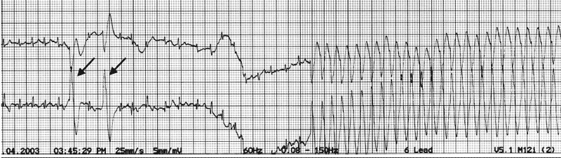 Simultaneous ECG rhythm strips recorded from a 7-year-old Irish wolfhound presented for collapse