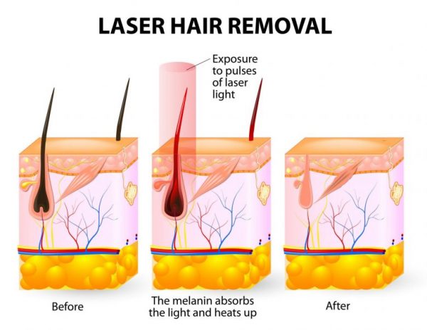 Phương pháp triệt lông bằng  Diod Laser có hiệu quả cao nhất
