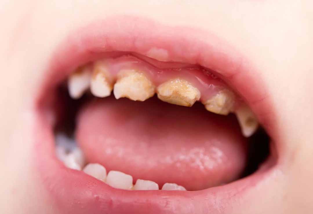 tác hại khi phụ huynh áp dụng sai cách vệ sinh răng cho trẻ 1 tuổi