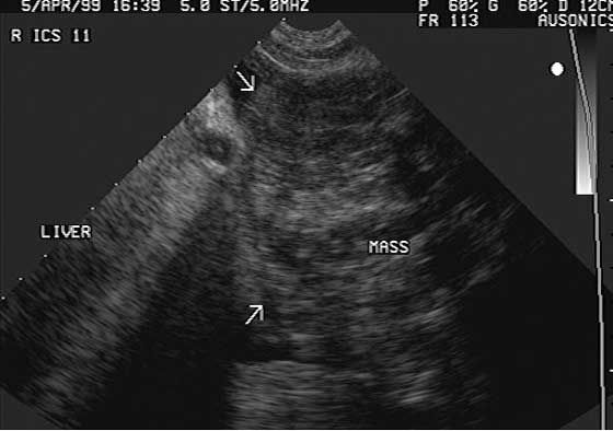 Sonogram of the right ventral lung obtained from a horse with primary pulmonary neoplasia.