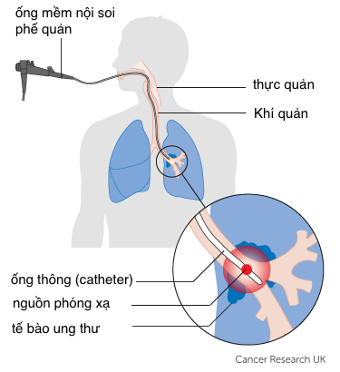 xạ trị ung thư phổi
