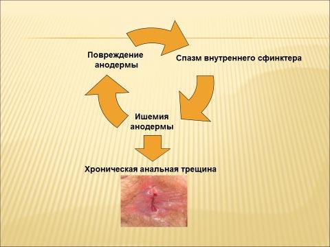 Иссечение анальной трещины лазером в Москве по доступной цене