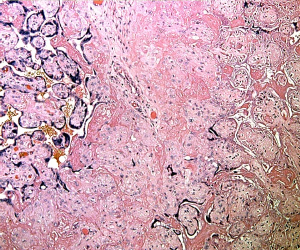At left is normal placental tissue, at right is one of the infarcts