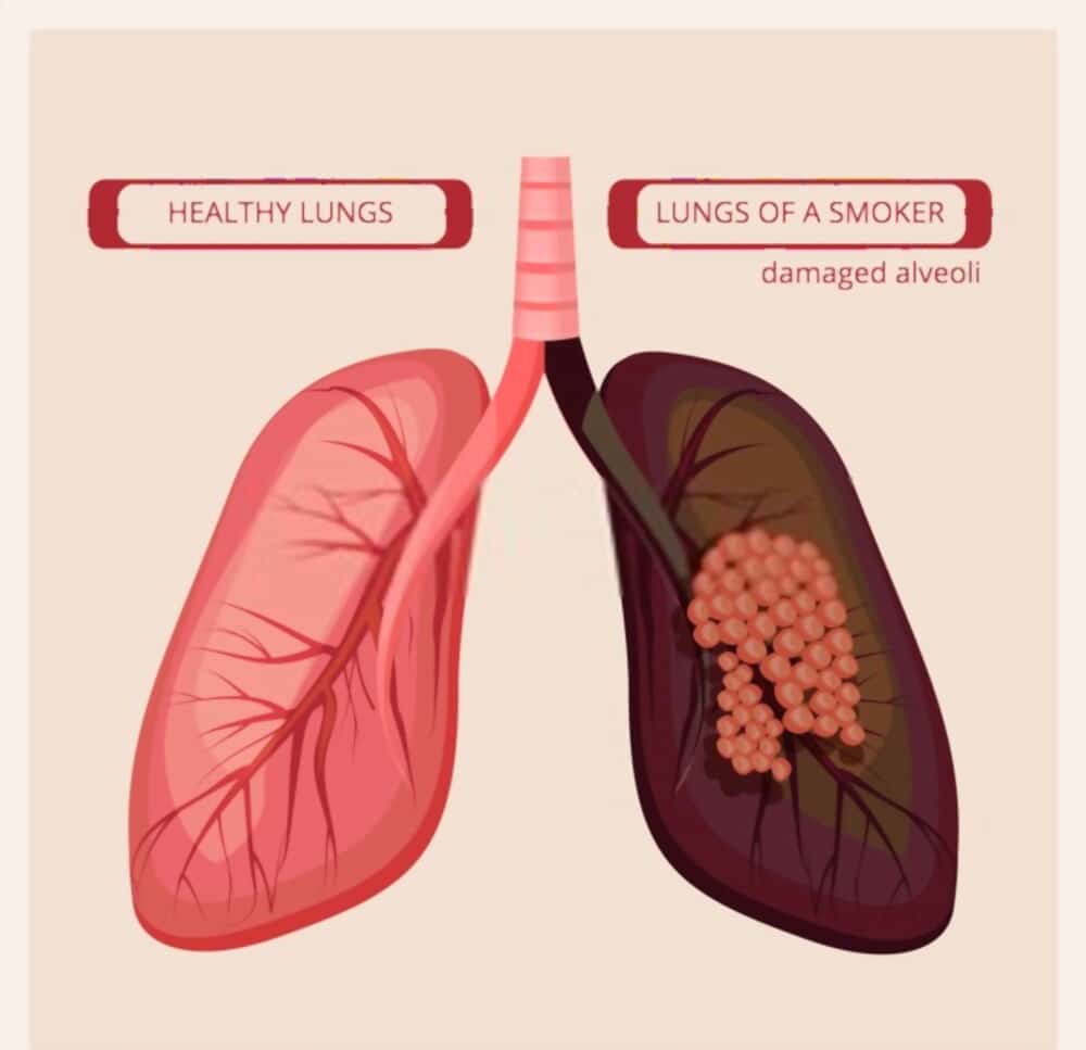 Healthy vs smokers' lungs