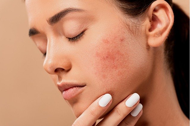 Acne blackhead facts and causes