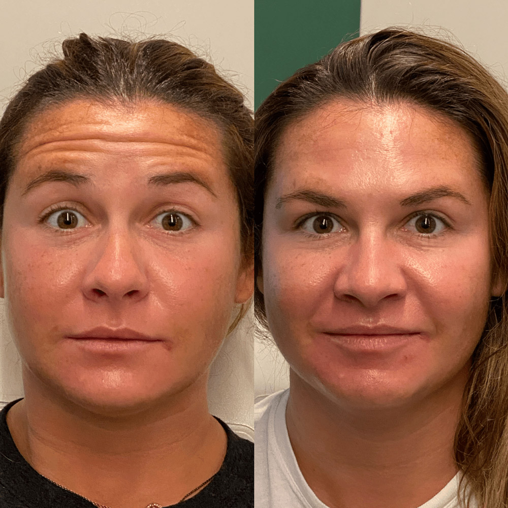 Side by side  picture of a lady showing the before and after treatment of the injections
