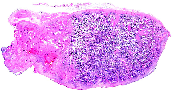 Complete section of the marginal portion of placental disk with marginal infarct