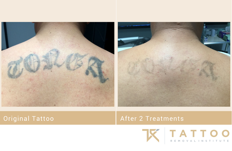 Laser Tattoo Removal Ultimate Guide | Tattoo Removal Institute