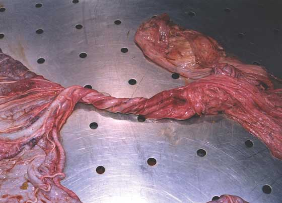Umbilical cord with non-reducible kink at allantoic end, indicating previous torsion. 