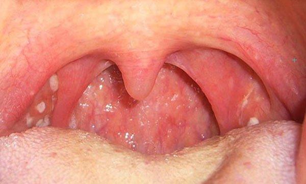 Ung thư hạ họng: Nguyên nhân, triệu chứng, chẩn đoán và điều trị | Vinmec