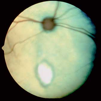 Central retinal degeneration in a cat suffering from taurine deficiency