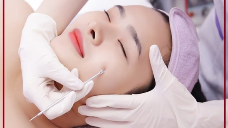 Nặn mụn đầu đen tại nhà 