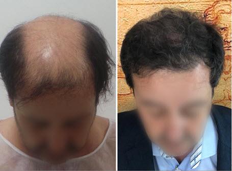 New discovery reveals hair loss treatment that ends Baldness regrows hair  naturally [SPONSORED] - Daily Post Nigeria