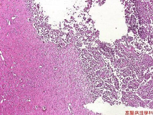 Histology image of pineal gland tumor