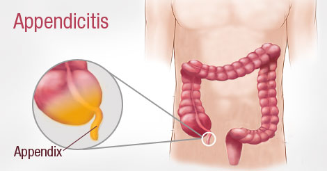 appendicitis.jpg