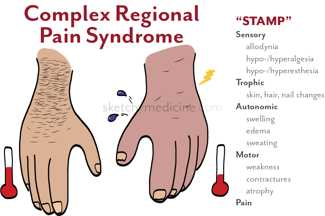 Complex Regional Pain Syndrome | Sketchy Medicine