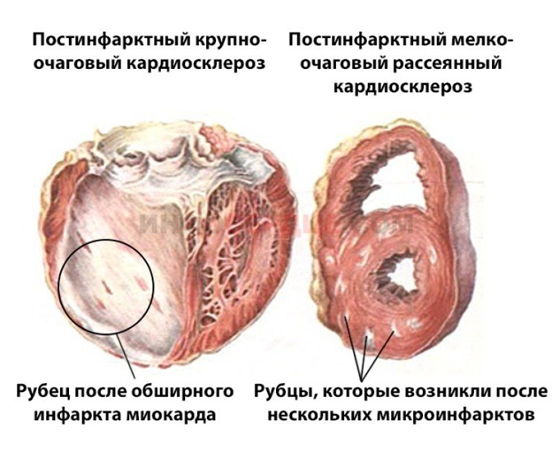 Лечение постинфарктного кардиосклероза