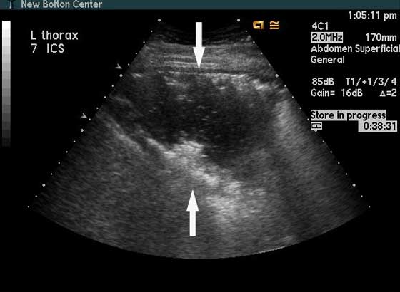 Sonogram of an anaerobic pleural abscess obtained from a horse with anaerobic pleuropneumonia.