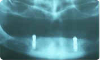 implant dentaire