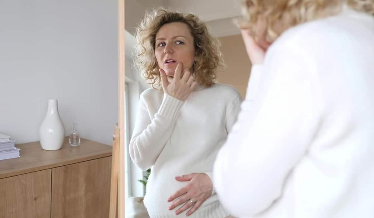 Acne During Pregnancy: Causes, Home Remedies & Treatment