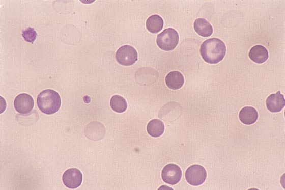 Spherocytes and ghost RBCs are present. The latter indicate some degree of intravascular lysis (100x).