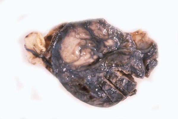 This 30 g placenta comes from a patas monkey gestation that was complicated by eclampsia and renal failure. The animal recovered from this illness. The specimen was about 20% infarcted and had vascular thrombi in the decidua (Courtesy Dr. W. Karesh, then at Seattle)