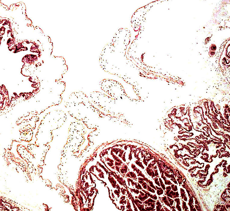 Surface of placenta with delicate amnion covering the villous tissue, an areola (left) in the chorion and villous tissue next to it on the right.