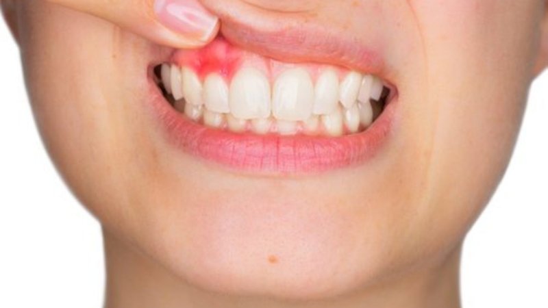 Vi khuẩn tấn công răng tạo ra túi mủ tại vị trí chân răng