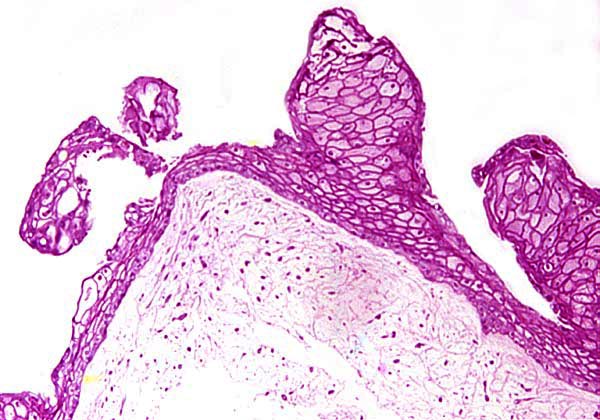 Surface squamous metaplasias of umbilical cord