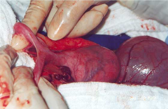 Transmissible venereal tumor in the cranial vagina of a 3 year old, crossbreed bitch
