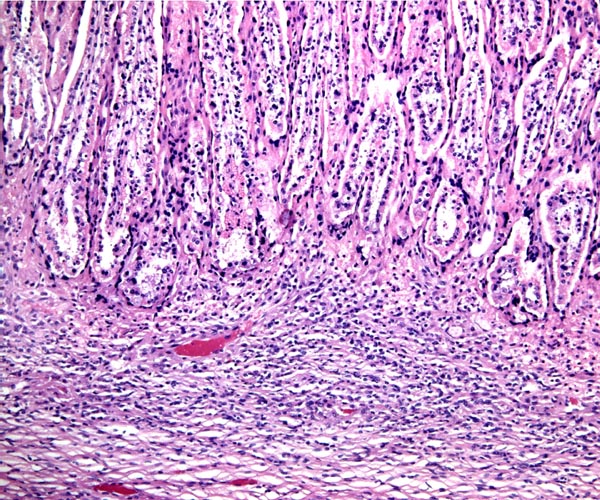 Base of young placentation of Thomson's gazelle. Infiltration/or modification of endometrium is apparent here. The pink maternal septa are interdigitated with fetal villi