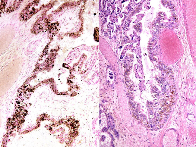 There is a layer of heavily pigmented trophoblast beneath the chorionic membrane of the older urial twin placenta. Left: Prussian blue reaction is negative