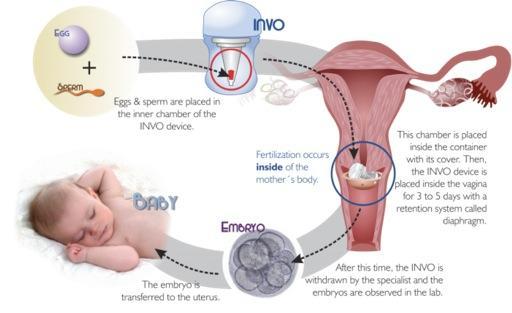 INVOcell - Virginia Center for Reproductive Medicine Virginia ...