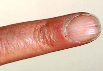 Skin infection pictures and treatments