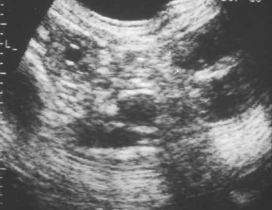 Day 22 uterine vesicle (gestational sac)