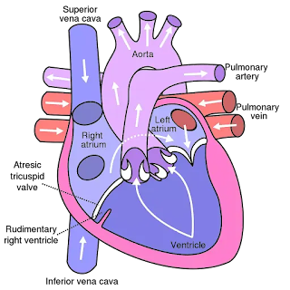 What is Tricuspid Atresia