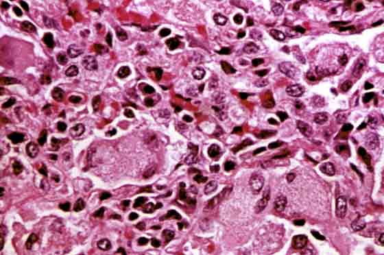 Detail from Figure 64, illustrating granulomatous pneumonia with prominent giant cells, macrophages lymphocytes and plasma cells.