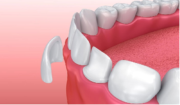 روکش دندان، راهی برای حل مشکل شکستگی های جزئی است