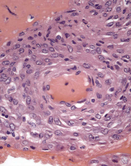 Spiral arteriole within the small amount of decidua basalis; very rare etravillous trophoblast infiltration is present