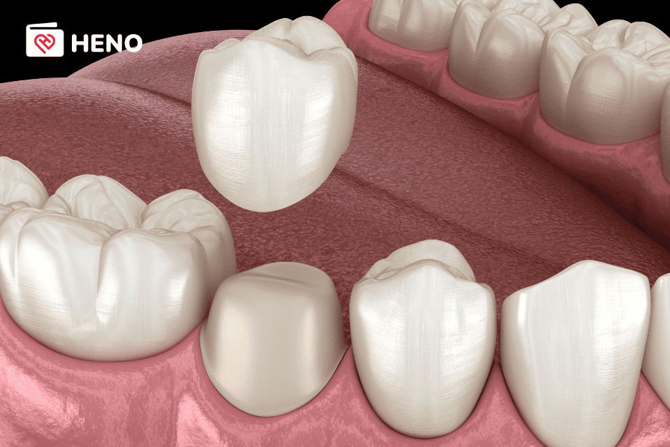 bọc răng sứ trực tiếp tại vị trí răng bị hư