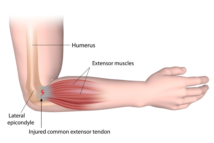 tennis-elbow-injury