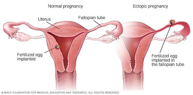 Normal vs. ectopic pregnancy