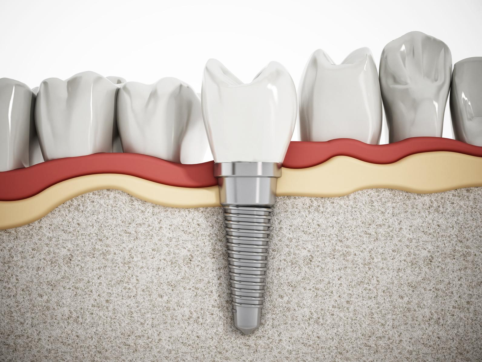 Ưu điểm của trồng răng Implant thay thế 1 răng