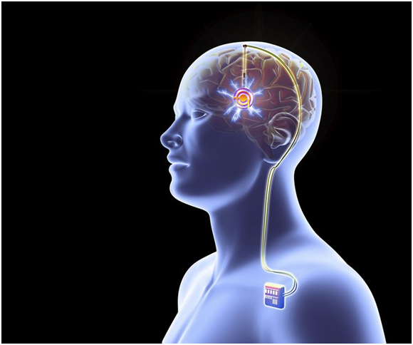brain chips in human beings