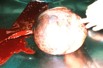 Ovarian hematoma surgically removed from a mare. This may actually be an enlarged hemorrhagic persistent anovulatory follicle. Surgical removal is not indicated.