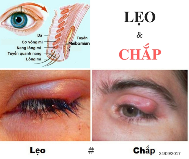 Phân biệt chắp và lẹo mắt